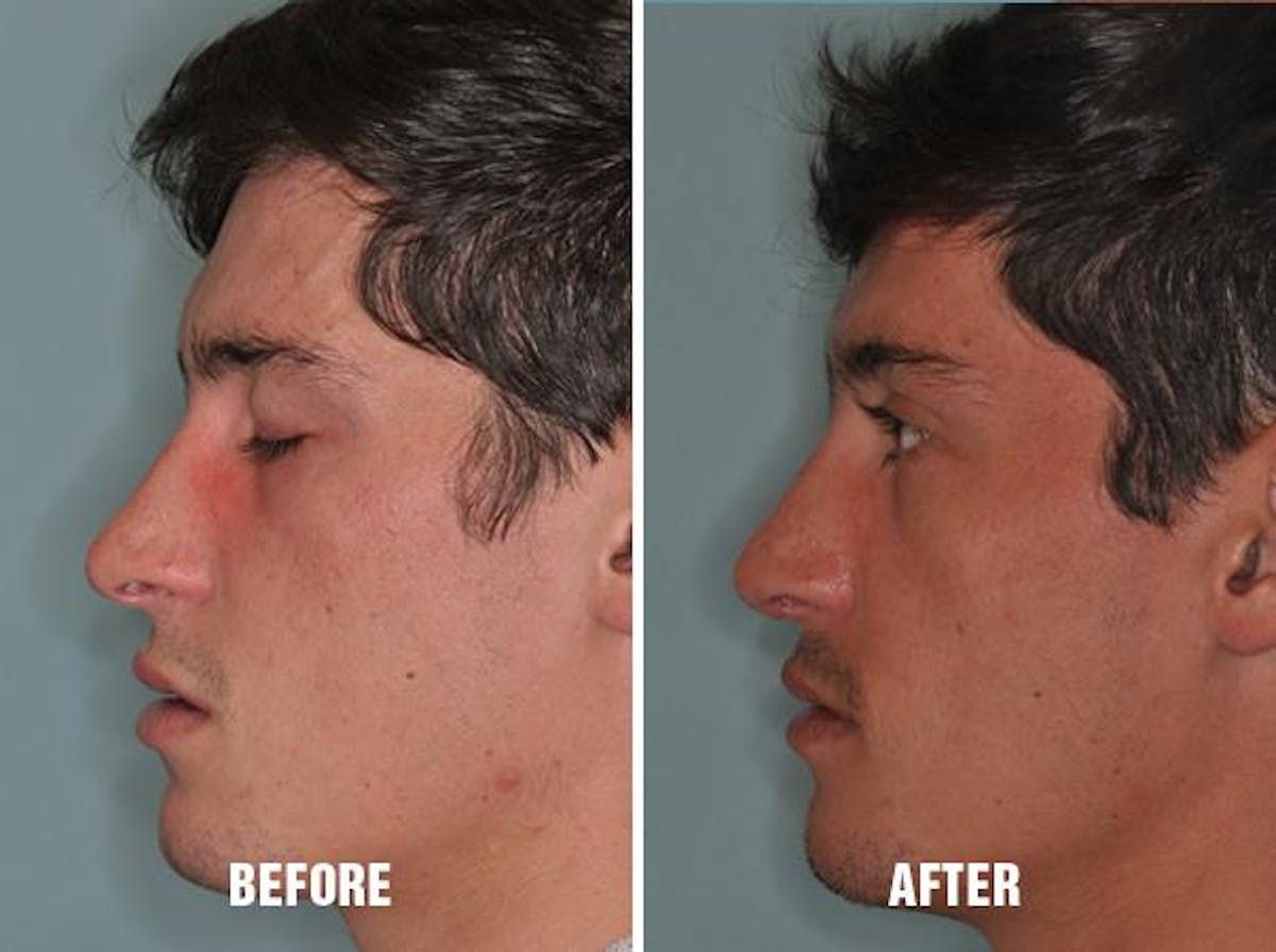 Rhinoplasty before and after, lateral left.