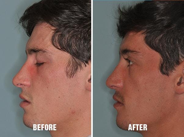 Rhinoplasty before and after, lateral left.