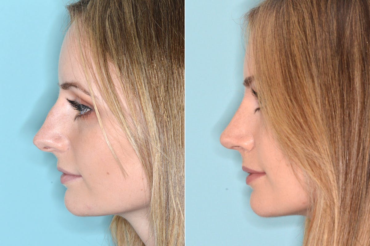 Rhinoplasty before and after, lateral left.