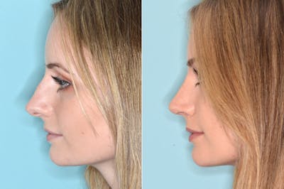 Rhinoplasty before and after, lateral left.