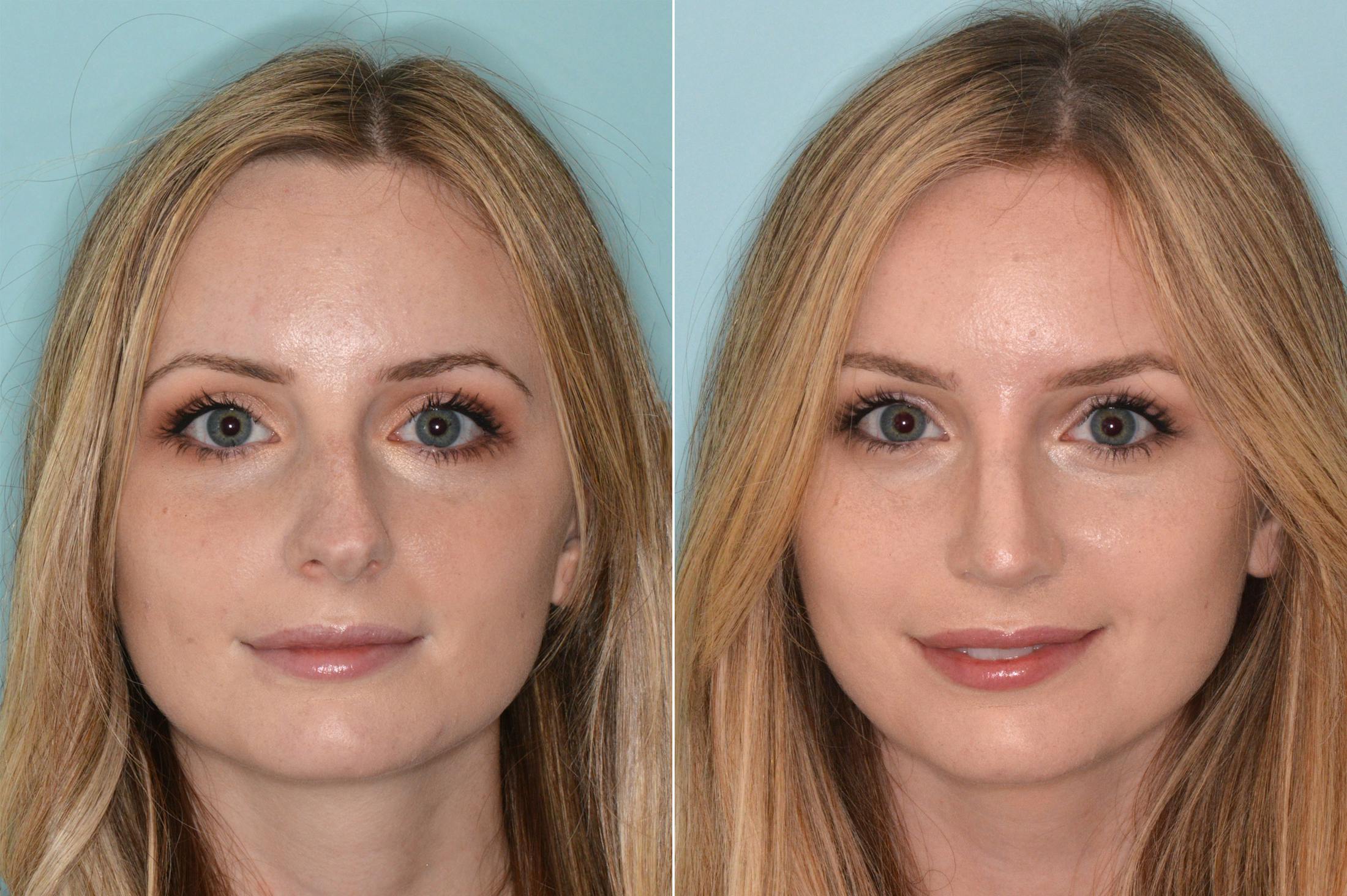Rhinoplasty before and after, frontal.