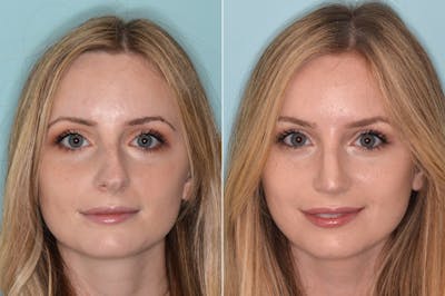 Rhinoplasty before and after, frontal.