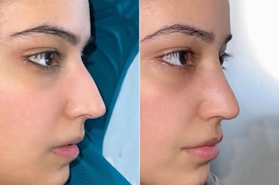 Rhinoplasty before and after, lateral right.