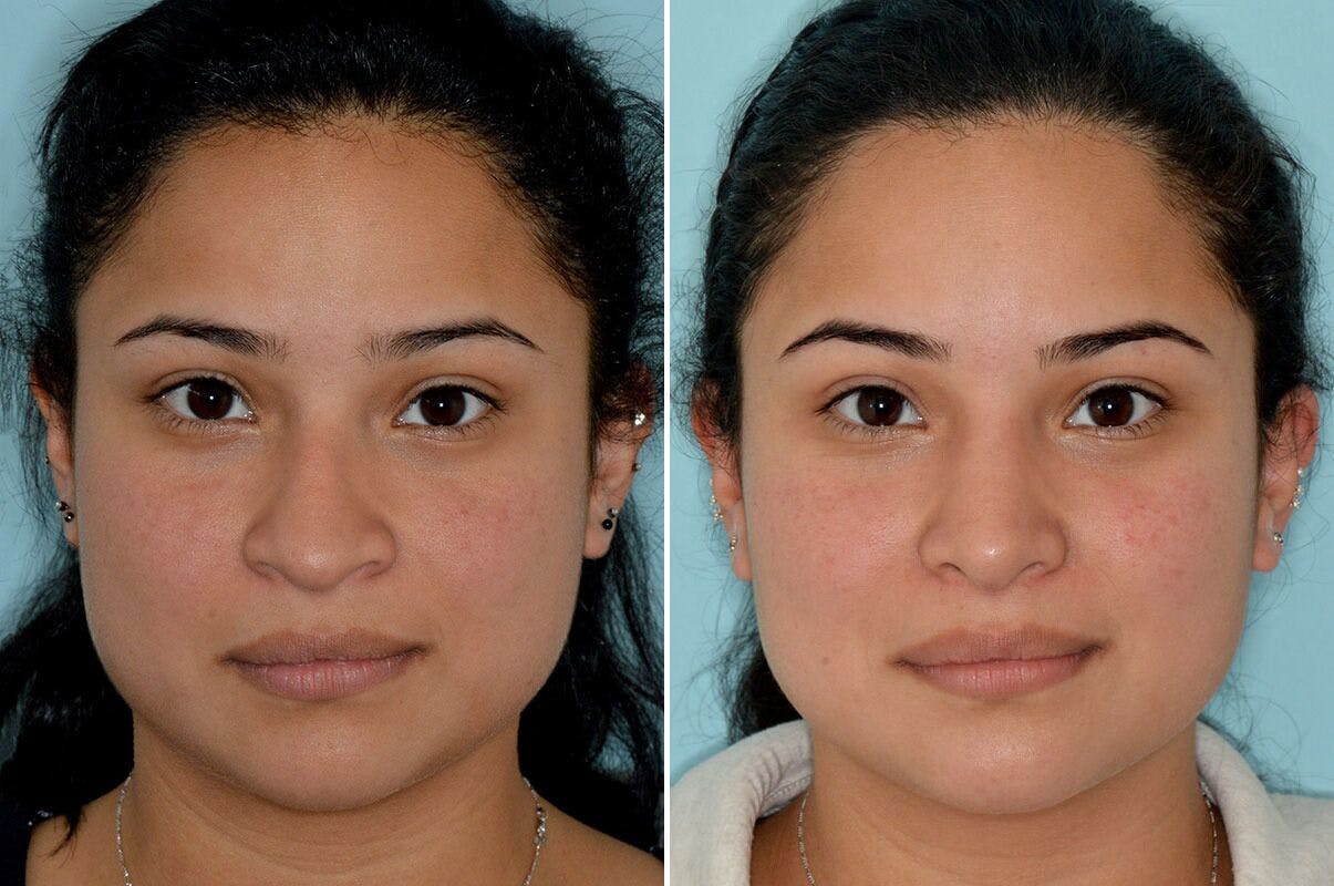 Rhinoplasty before and after, frontal.