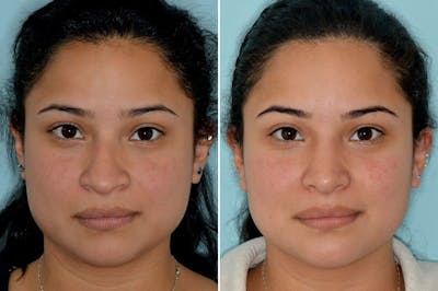 Rhinoplasty before and after, frontal.