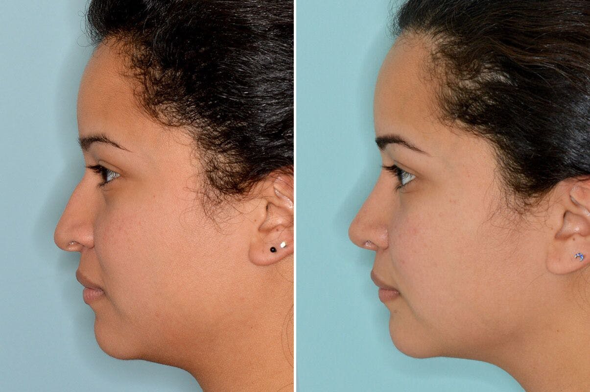 Rhinoplasty before and after, lateral left.