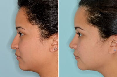 Rhinoplasty before and after, lateral left.