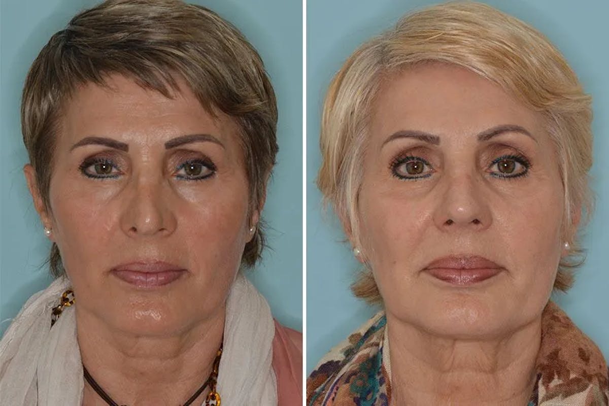 Revision Rhinoplasty before and after, frontal.