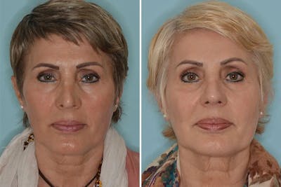 Revision Rhinoplasty before and after, frontal.