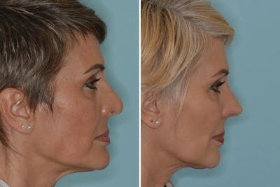 Revision Rhinoplasty before and after, lateral right.