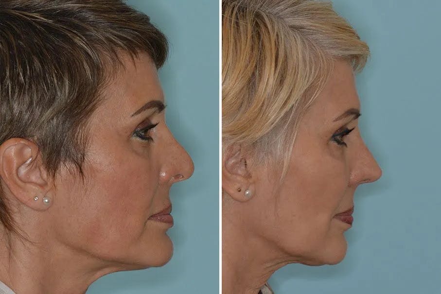 Revision Rhinoplasty before and after, lateral right.