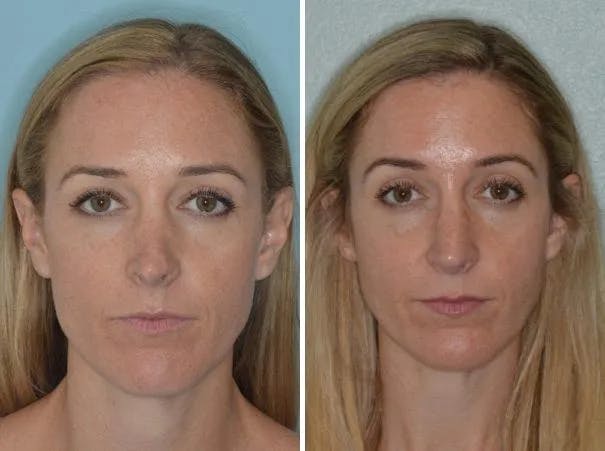 Revision Rhinoplasty before and after, frontal.