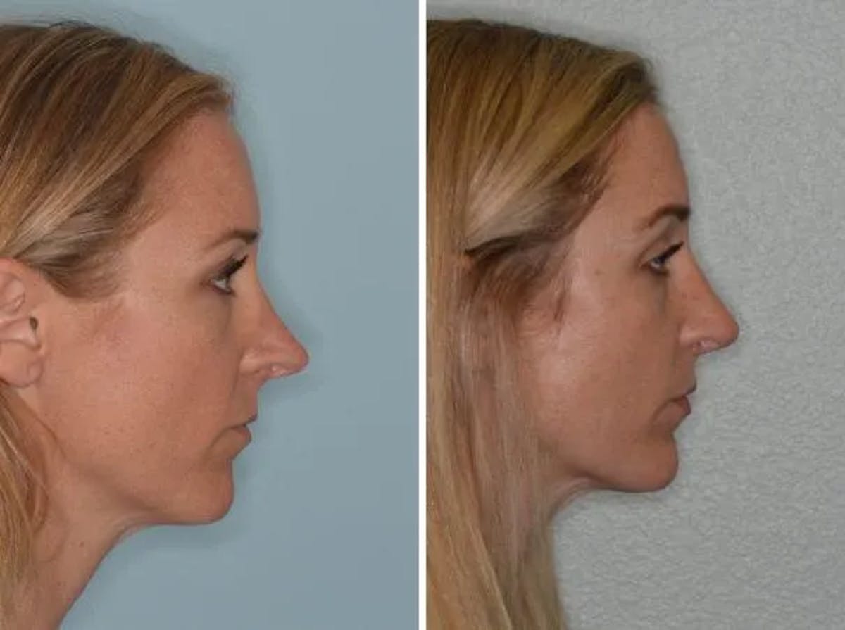 Revision Rhinoplasty before and after, lateral right.