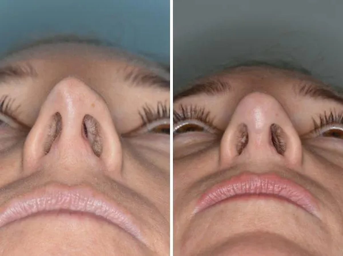 Revision Rhinoplasty before and after, frontal.