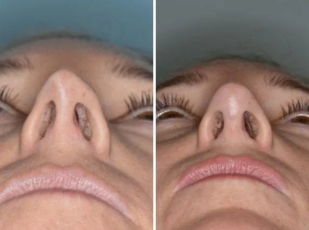 Revision Rhinoplasty before and after, frontal.