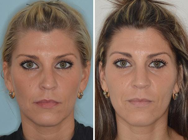 Revision Rhinoplasty before and after, frontal.