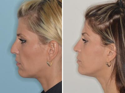 Revision Rhinoplasty before and after, lateral left.