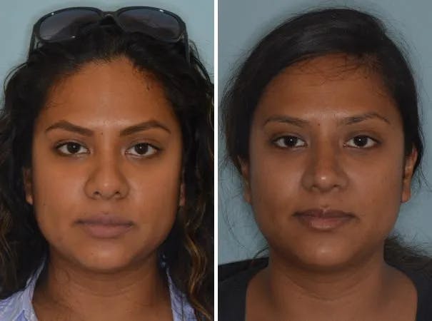 Revision Rhinoplasty before and after, frontal.