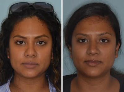 Revision Rhinoplasty before and after, frontal.