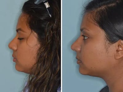 Revision Rhinoplasty before and after, lateral left.