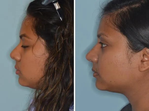 Revision Rhinoplasty before and after, lateral left.