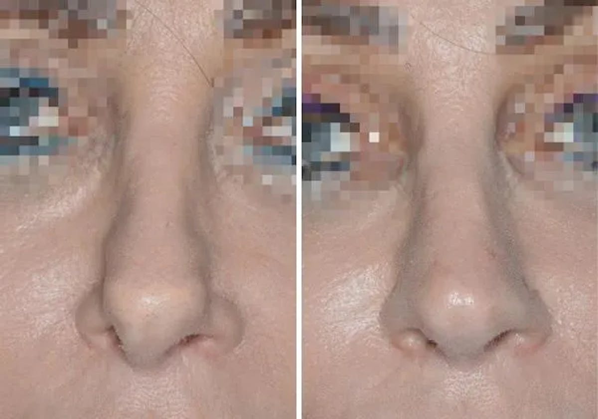 Revision Rhinoplasty before and after, frontal.