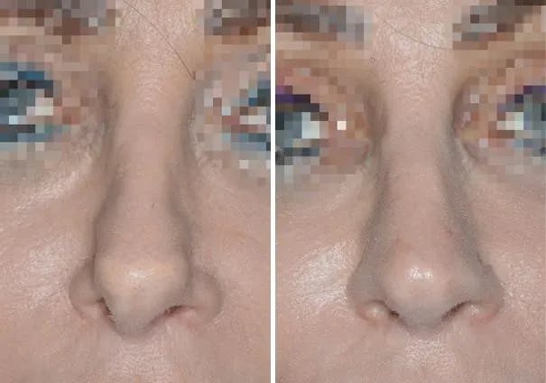 Revision Rhinoplasty before and after, frontal.