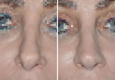 Revision Rhinoplasty before and after, frontal.