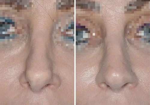 Revision Rhinoplasty before and after, frontal.