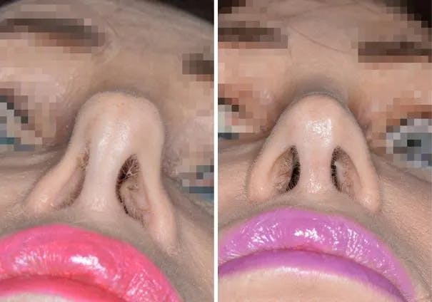 Revision Rhinoplasty before and after, frontal.