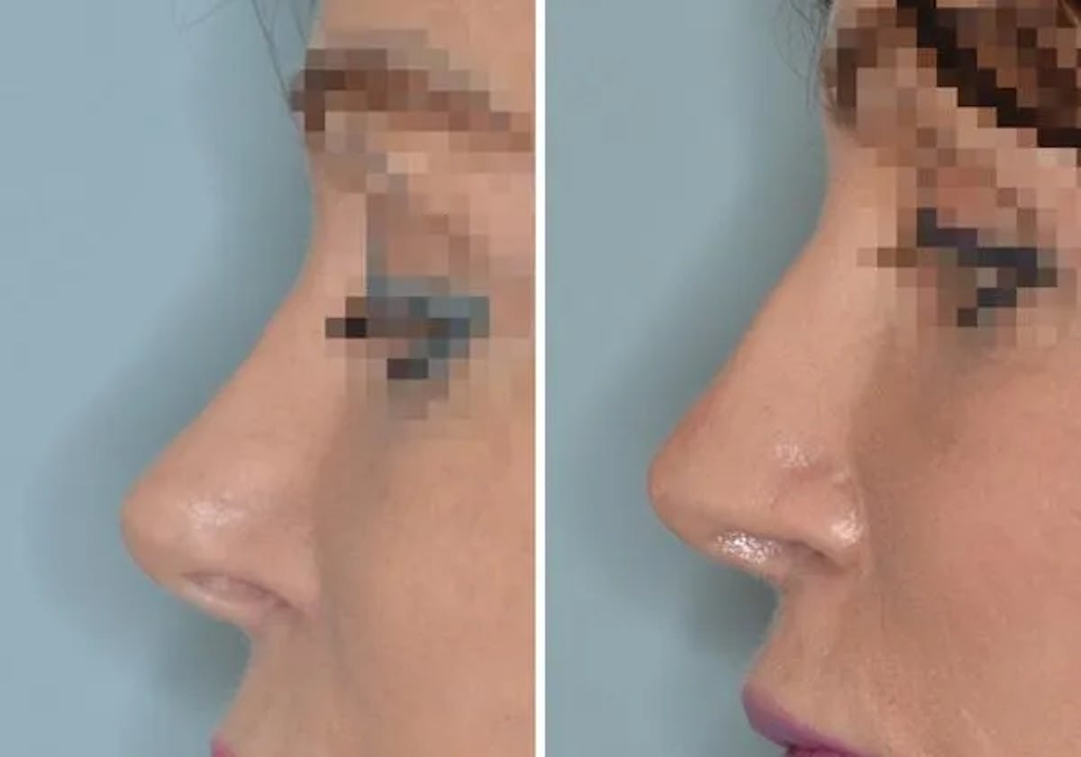 Revision Rhinoplasty before and after, lateral left.