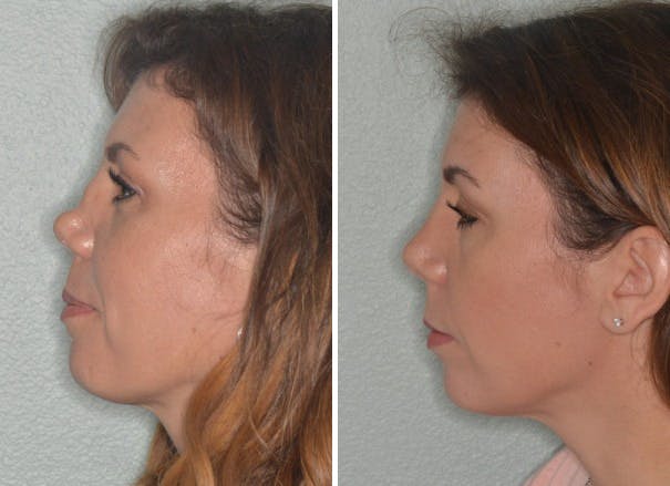 Revision Rhinoplasty before and after, lateral left.