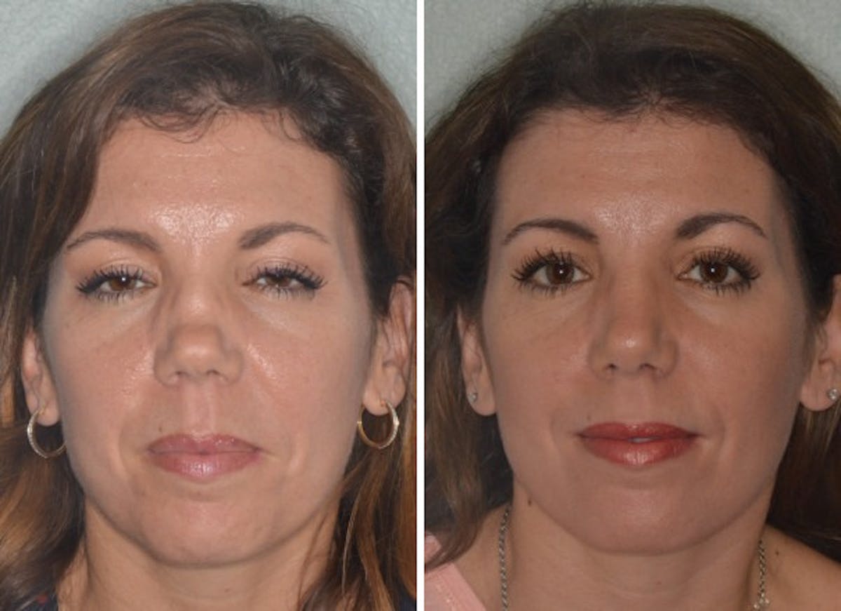 Revision Rhinoplasty before and after, frontal.