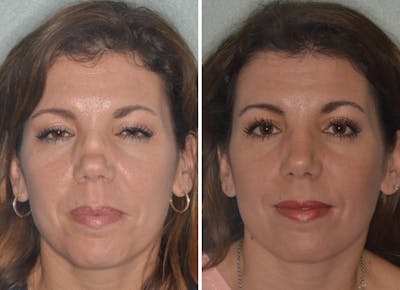 Revision Rhinoplasty before and after, frontal.
