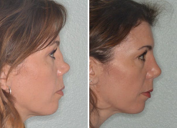 Revision Rhinoplasty before and after, lateral right.