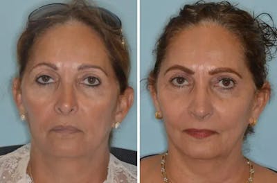Revision Rhinoplasty before and after, frontal.