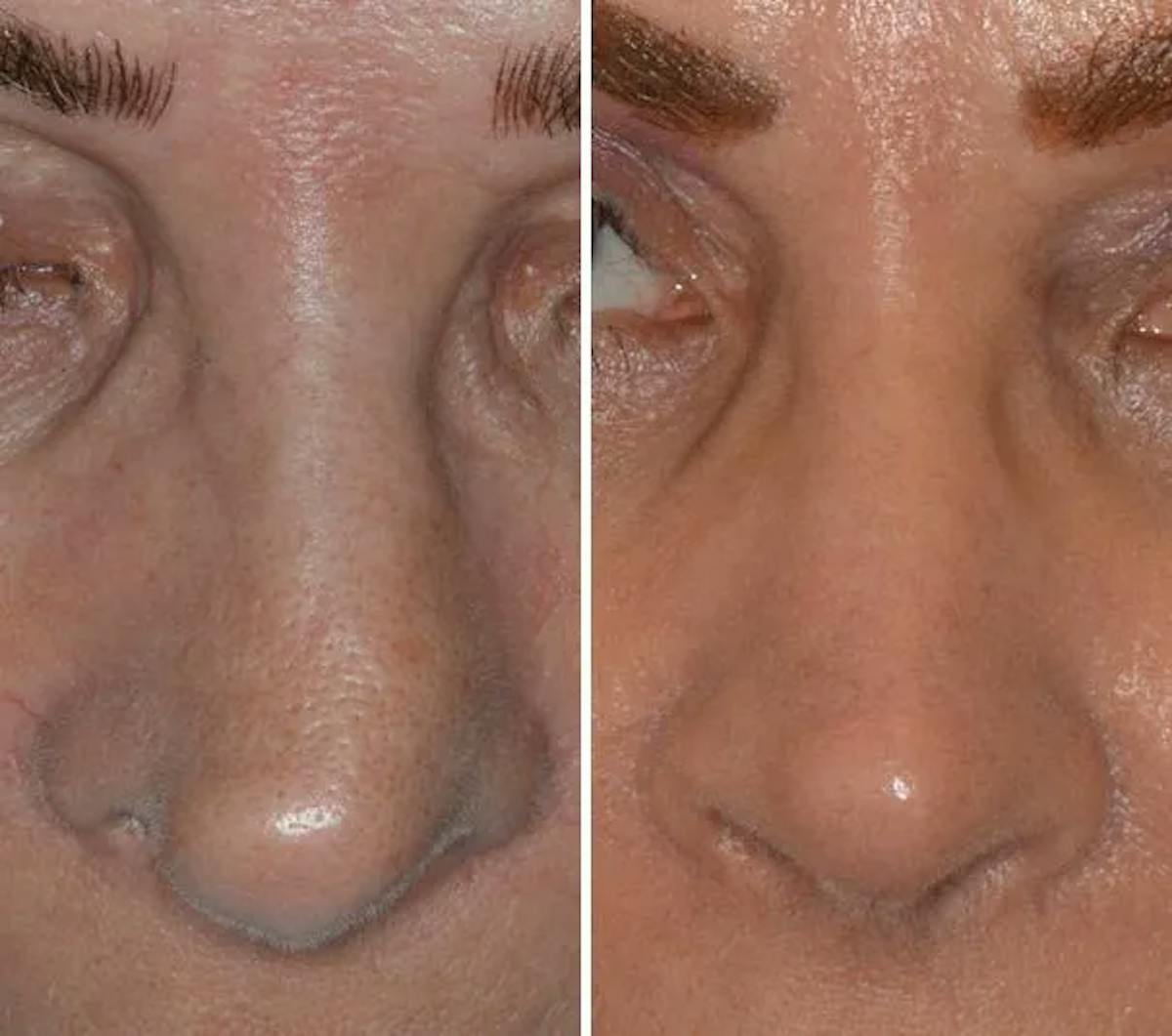 Revision Rhinoplasty before and after, frontal.