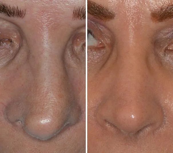 Revision Rhinoplasty before and after, frontal.