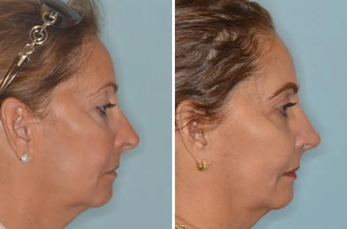 Revision Rhinoplasty before and after, lateral right.