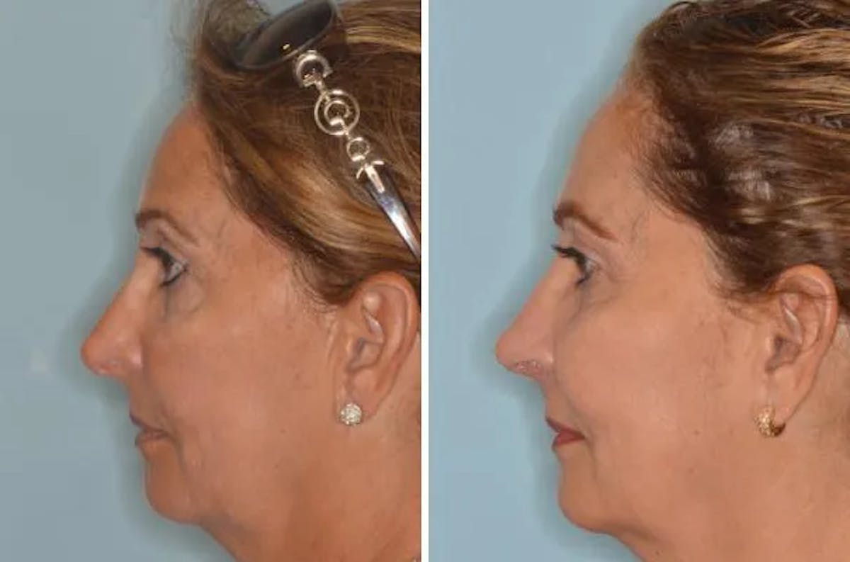 Revision Rhinoplasty before and after, lateral left.