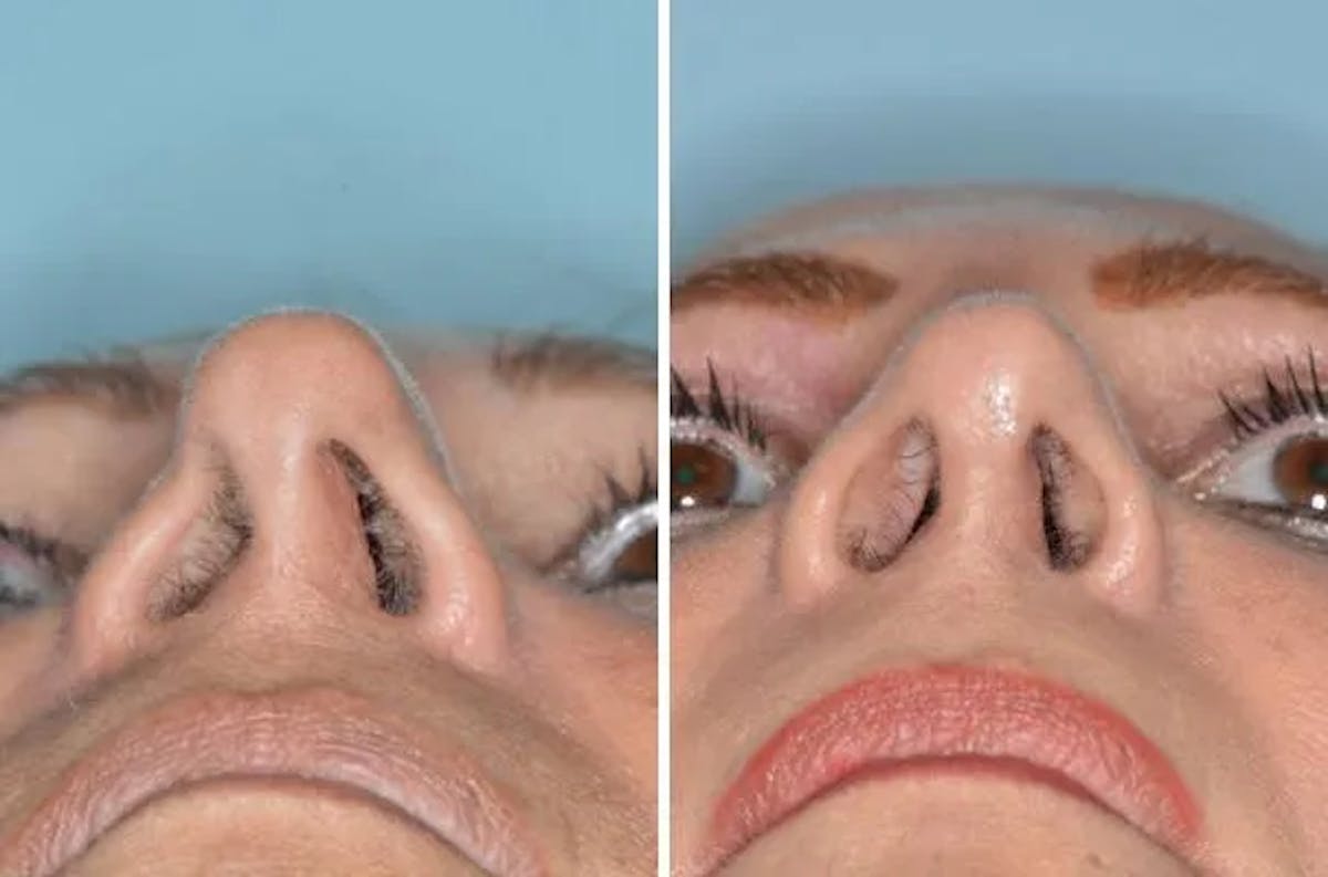 Revision Rhinoplasty before and after, frontal.