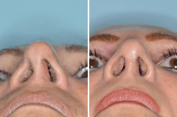 Revision Rhinoplasty before and after, frontal.