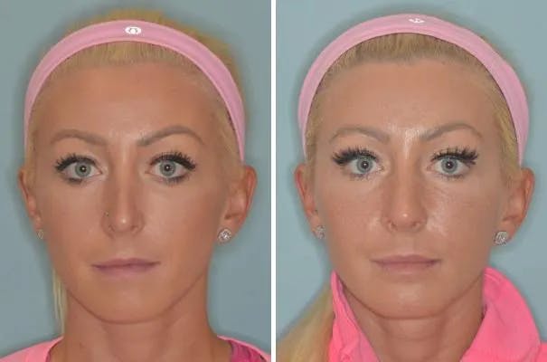 Revision Rhinoplasty before and after, frontal.