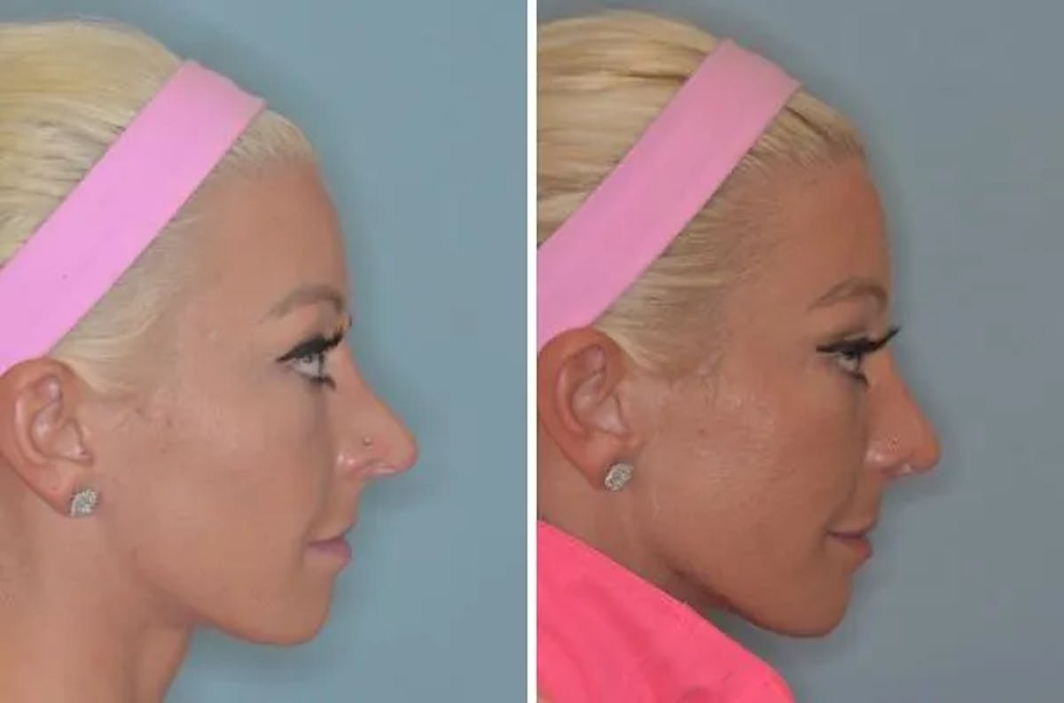 Revision Rhinoplasty before and after, lateral right.