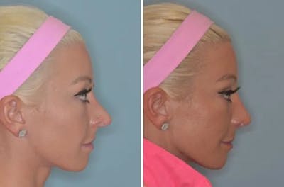 Revision Rhinoplasty before and after, lateral right.