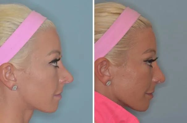 Revision Rhinoplasty before and after, lateral right.
