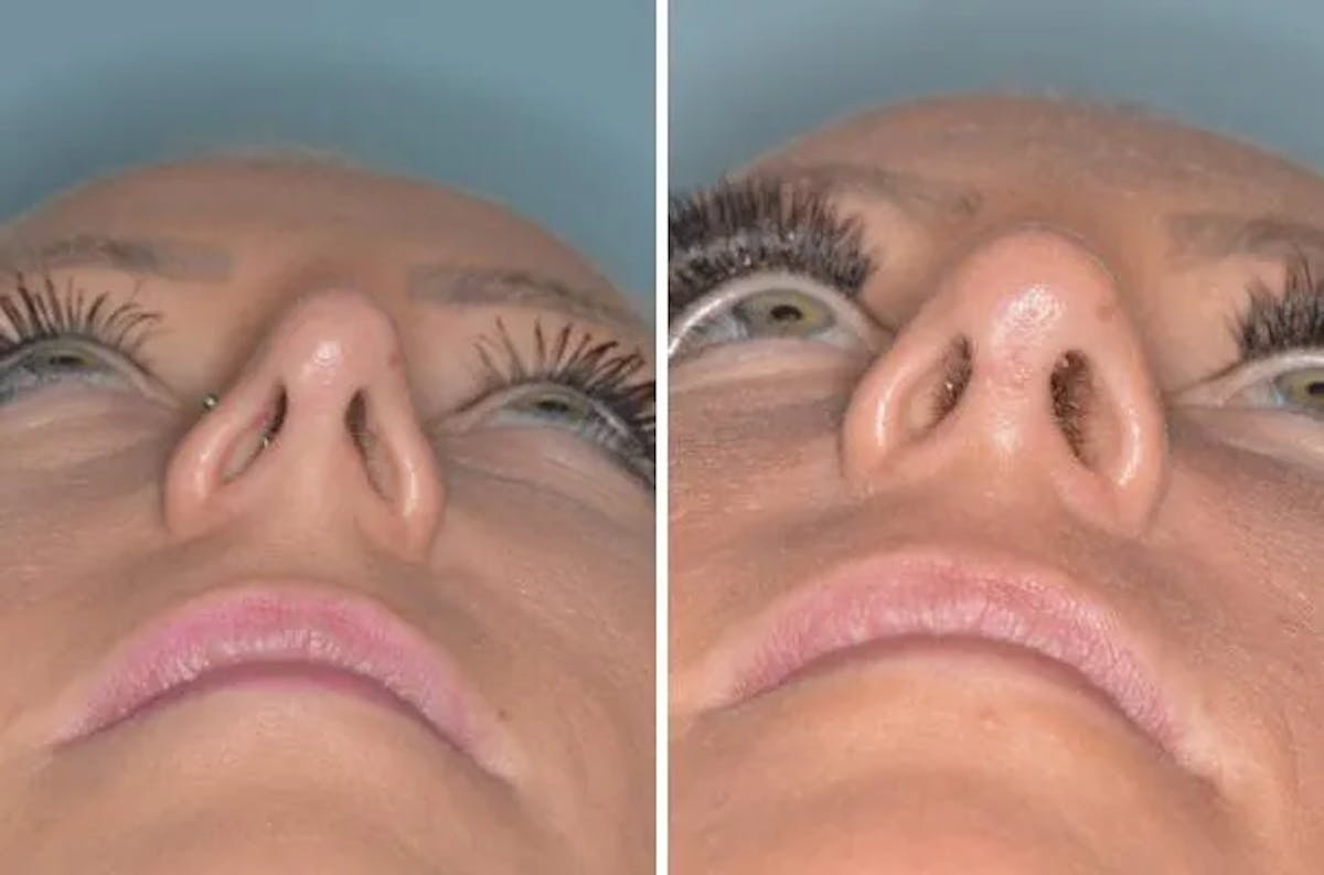 Revision Rhinoplasty before and after, frontal.