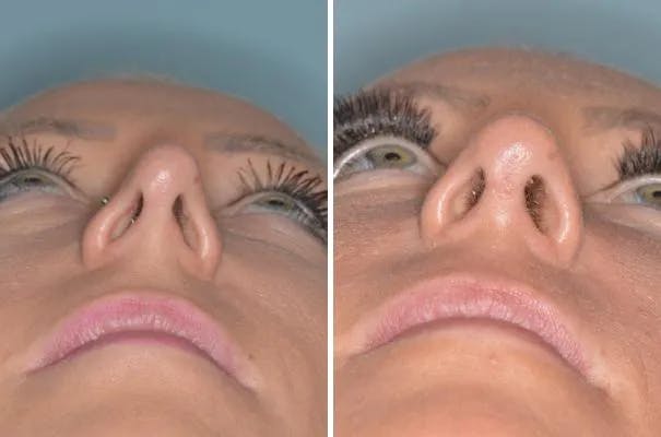 Revision Rhinoplasty before and after, frontal.