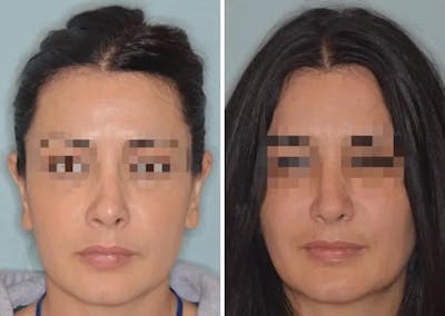Revision Rhinoplasty before and after, frontal.