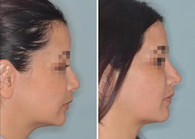 Revision Rhinoplasty before and after, lateral right.